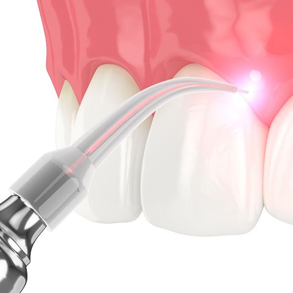 Get Laser Periodontal Treatment In Beverly Hills, CA